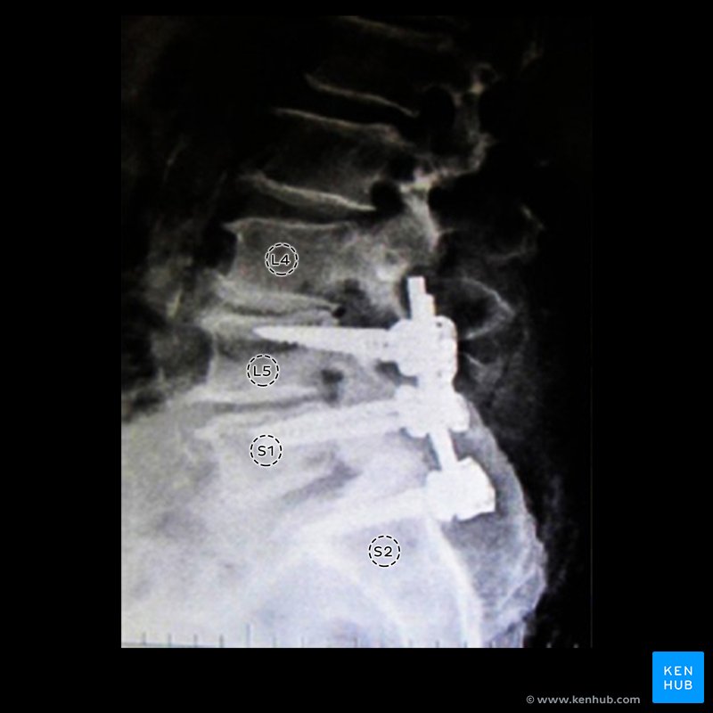 Bilateral pedicular screw fixation - lateral view