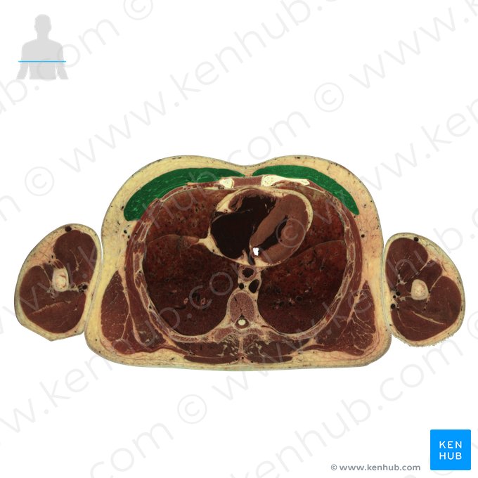 Pectoralis major muscle (Musculus pectoralis major); Image: National Library of Medicine