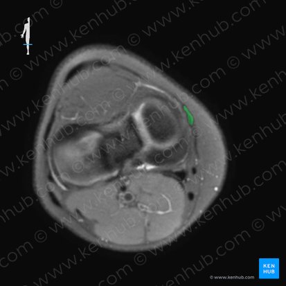Tibial collateral ligament of knee joint (Ligamentum collaterale tibiale genus); Image: 