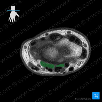 Flexor digitorum profundus muscle (Musculus flexor digitorum profundus); Image: 