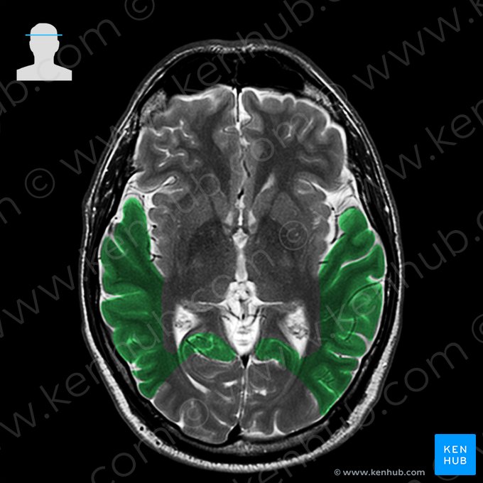 Lóbulo temporal (Lobus temporalis); Imagen: 