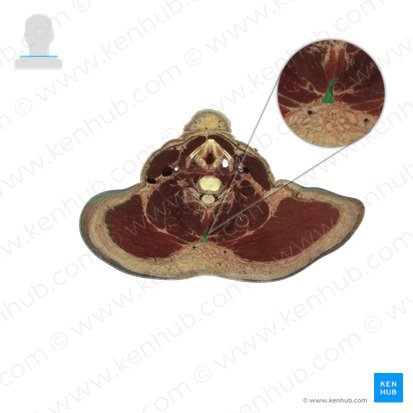Nuchal ligament (Ligamentum nuchae); Image: National Library of Medicine