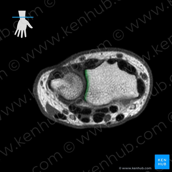 Incisura ulnar del radio (Incisura ulnaris radii); Imagen: 