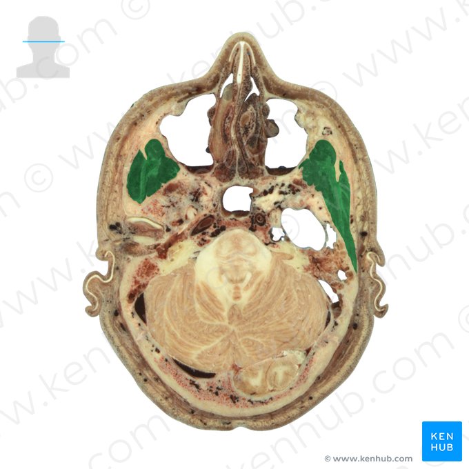 Temporalis muscle (Musculus temporalis); Image: National Library of Medicine