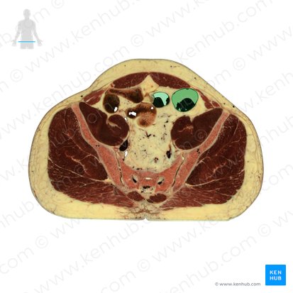 Sigmoid colon (Colon sigmoideum); Image: National Library of Medicine