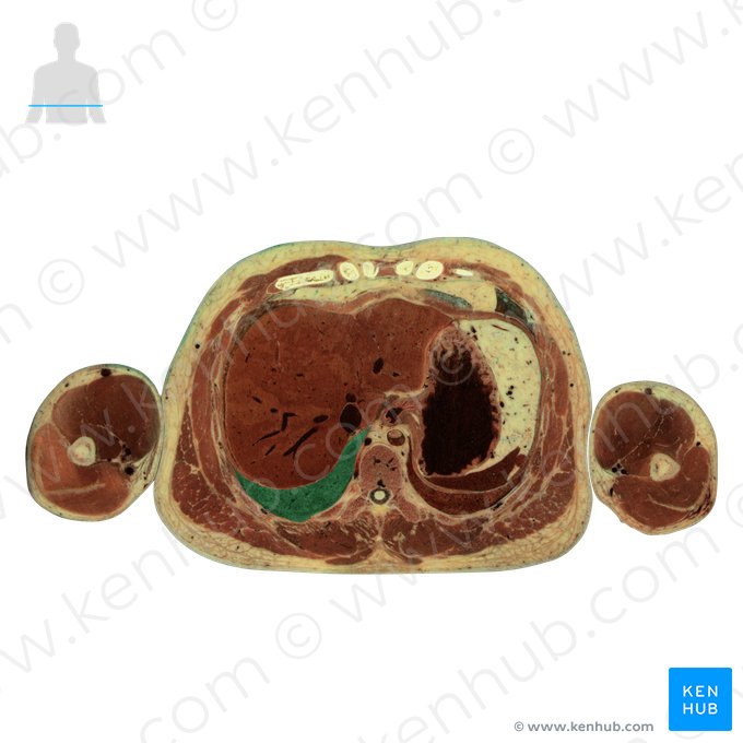 Lobo inferior do pulmão direito (Lobus inferior pulmonis dextri); Imagem: National Library of Medicine