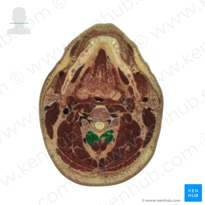 Multifidus muscle (Musculus multifidus); Image: National Library of Medicine