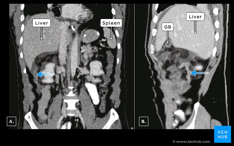 CT images of subhepatic inflamed appendix