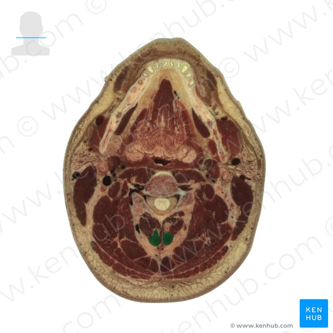 Semispinalis cervicis muscle (Musculus semispinalis cervicis); Image: National Library of Medicine