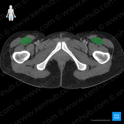 Musculus rectus femoris (Gerader Oberschenkelmuskel); Bild: 