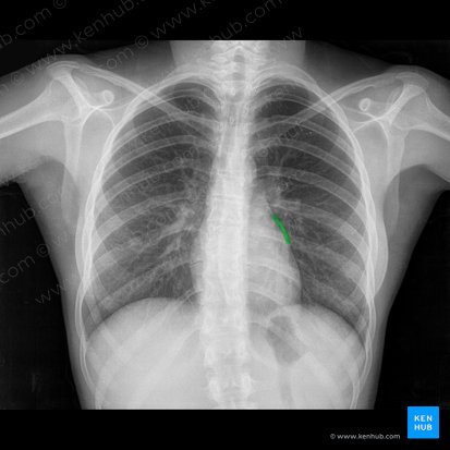 Border of left atrium (Margo atrii sinistri); Image: 