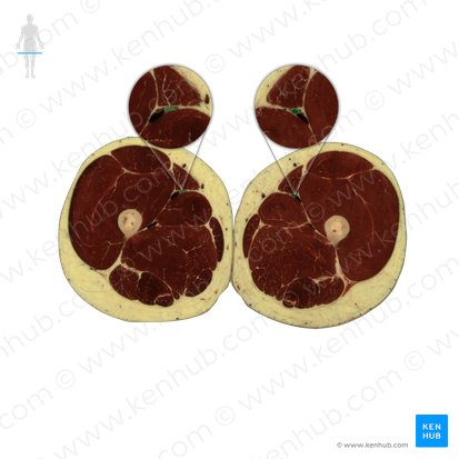 Arteria femoralis (Oberschenkelarterie); Bild: National Library of Medicine