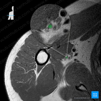 Arteria circumflexa anterior humeri (Vordere Oberarmkranzarterie); Bild: 