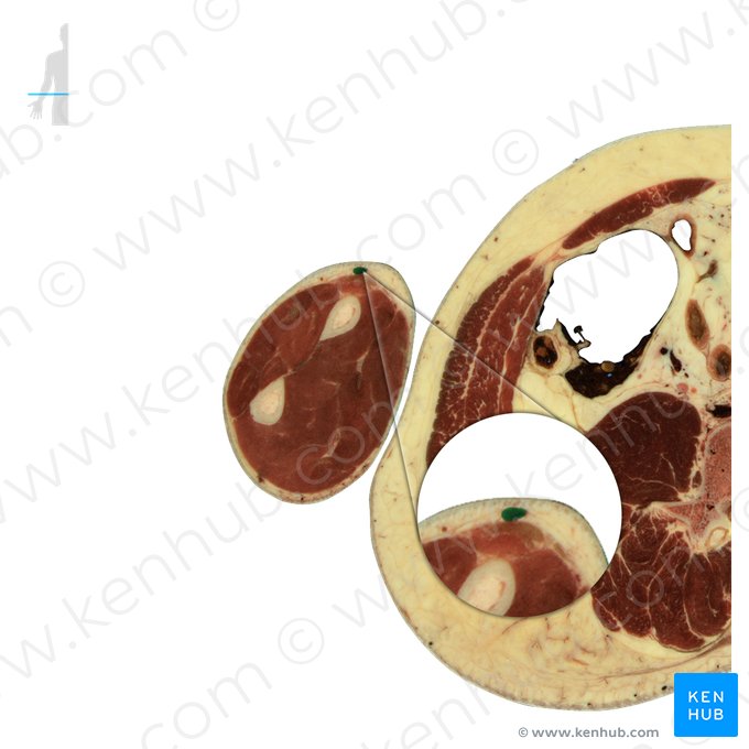 Vena cephalica (Kopfvene); Bild: National Library of Medicine