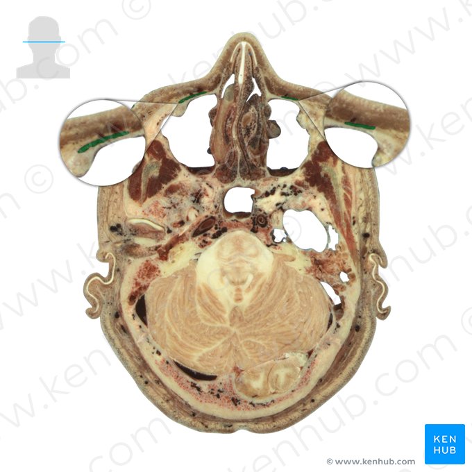 Levator labii superioris muscle (Musculus levator labii superioris); Image: National Library of Medicine