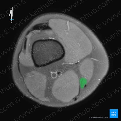 Músculo grácil (Musculus gracilis); Imagem: 