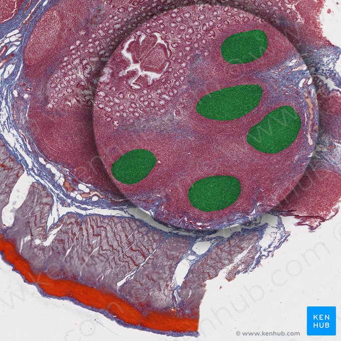 Placas de Peyer (Noduli lymphoidei aggregati ilei); Imagem: 