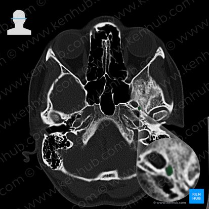 Foramen spinosum; Image: 