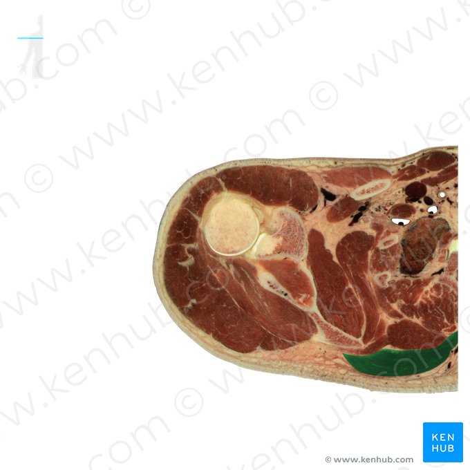 Trapezius muscle (Musculus trapezius); Image: National Library of Medicine