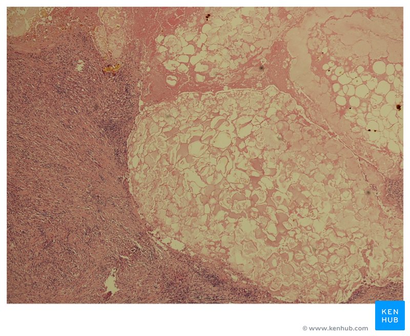 Pericolonic scarring and inflammation surrounding pancreatic fat necrotic foci