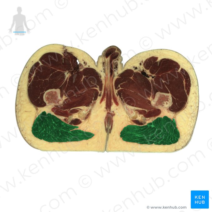 Gluteus maximus muscle (Musculus gluteus maximus); Image: National Library of Medicine