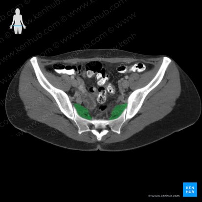 Músculo piriforme (Musculus piriformis); Imagen: 