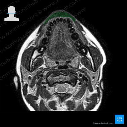 Orbicularis oris muscle (Musculus orbicularis oris); Image: 