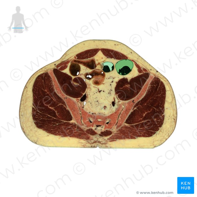 Sigmoid colon (Colon sigmoideum); Image: National Library of Medicine