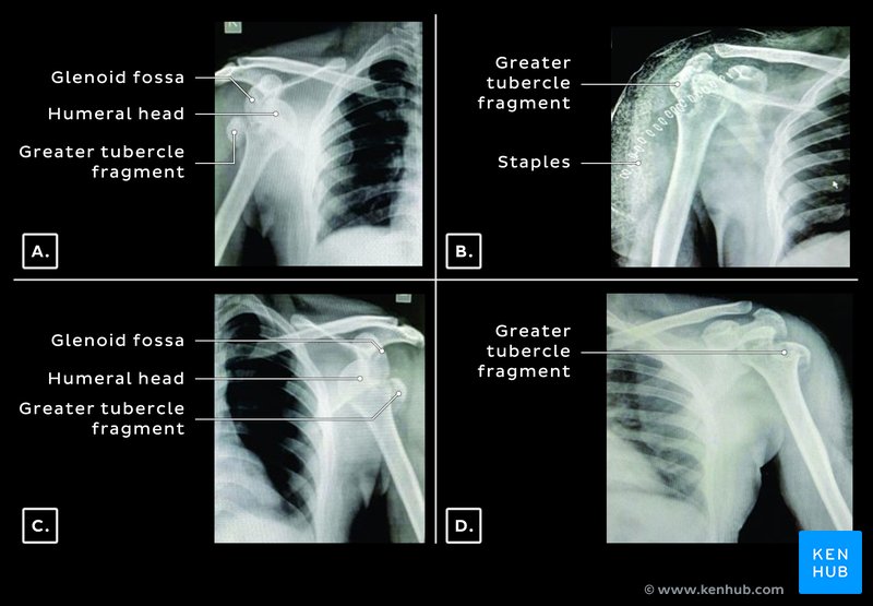 Bilateral anterior shoulder dislocations - X-rays