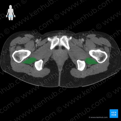 Quadratus femoris muscle (Musculus quadratus femoris); Image: 