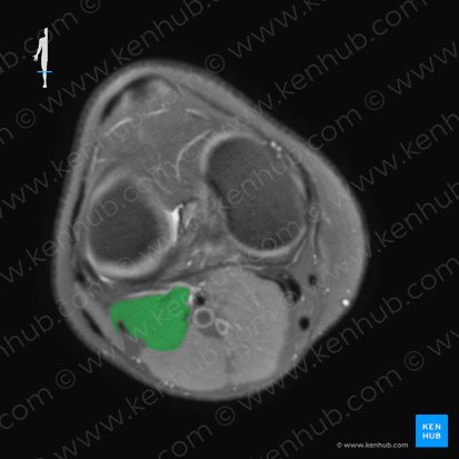 Musculus plantaris (Fußsohlenmuskel); Bild: 