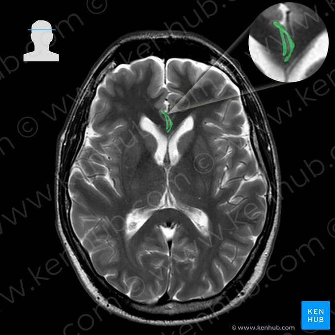 Arteria cerebral anterior (Arteria anterior cerebri); Imagen: 