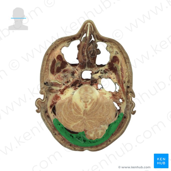 Osso occipital (Os occipitale); Imagem: National Library of Medicine