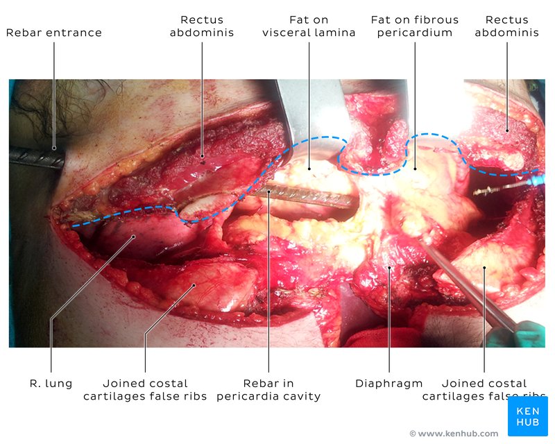 Intraoperative photograph showing rebar within the thoracic and pericardial cavities