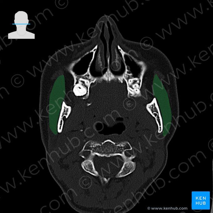 Musculus masseter (Kaumuskel); Bild: 