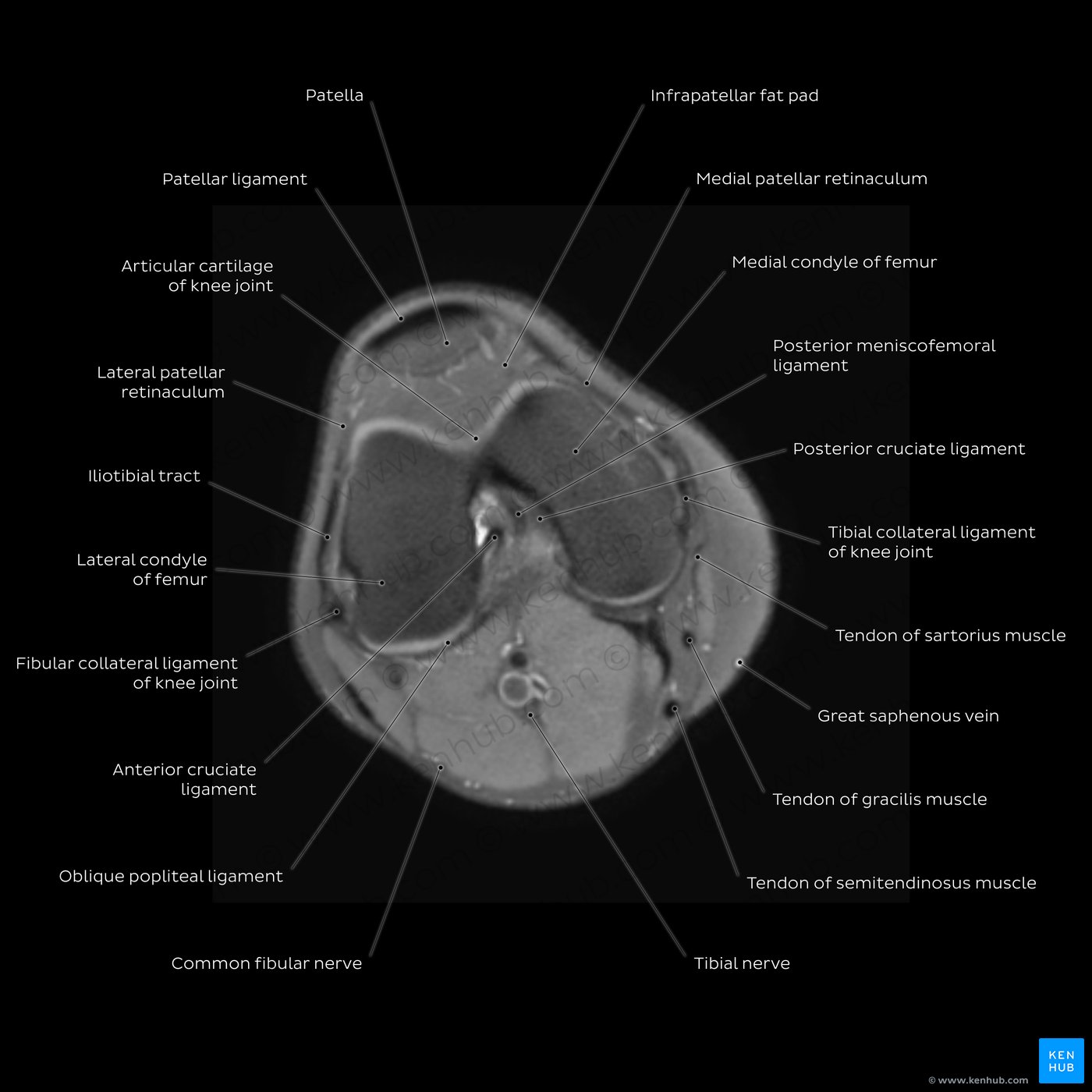Knee MRI PD overview: Femoral condyles level