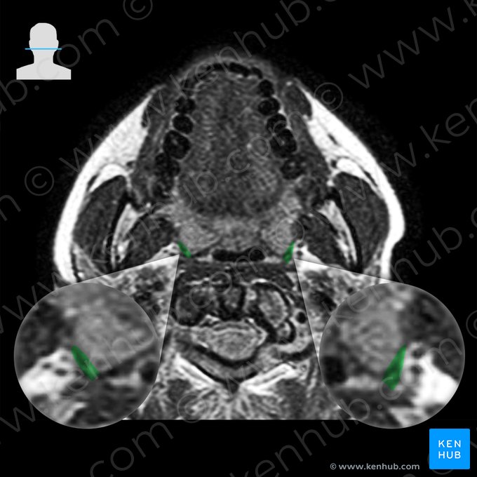 Músculo constritor superior da farínge (Musculus constrictor pharyngis superior); Imagem: 