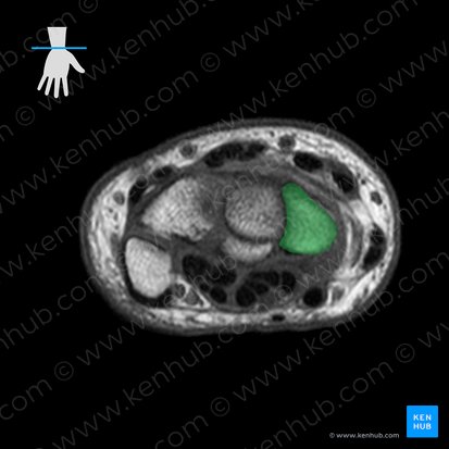 Scaphoid bone (Os scaphoideum); Image: 