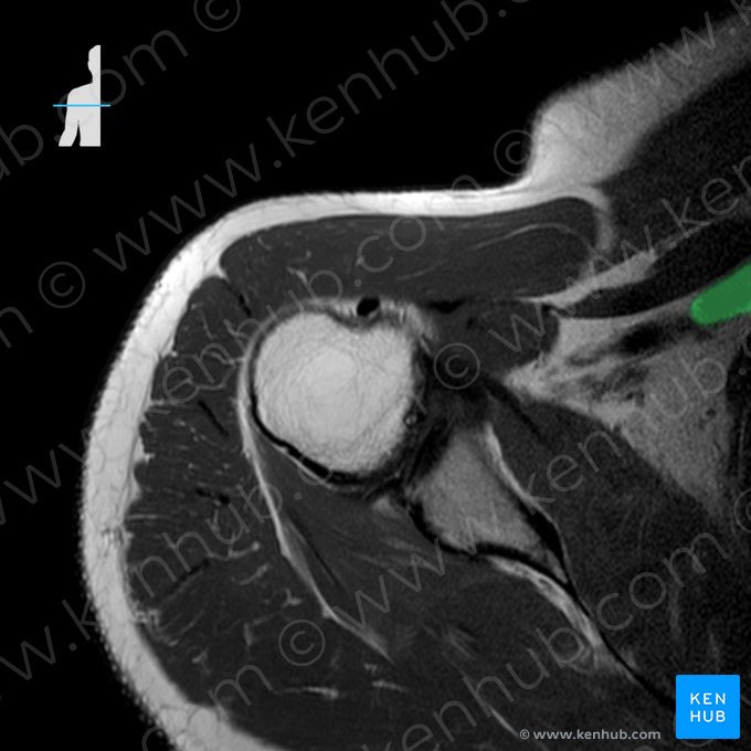 Vena axillaris (Achselvene); Bild: 