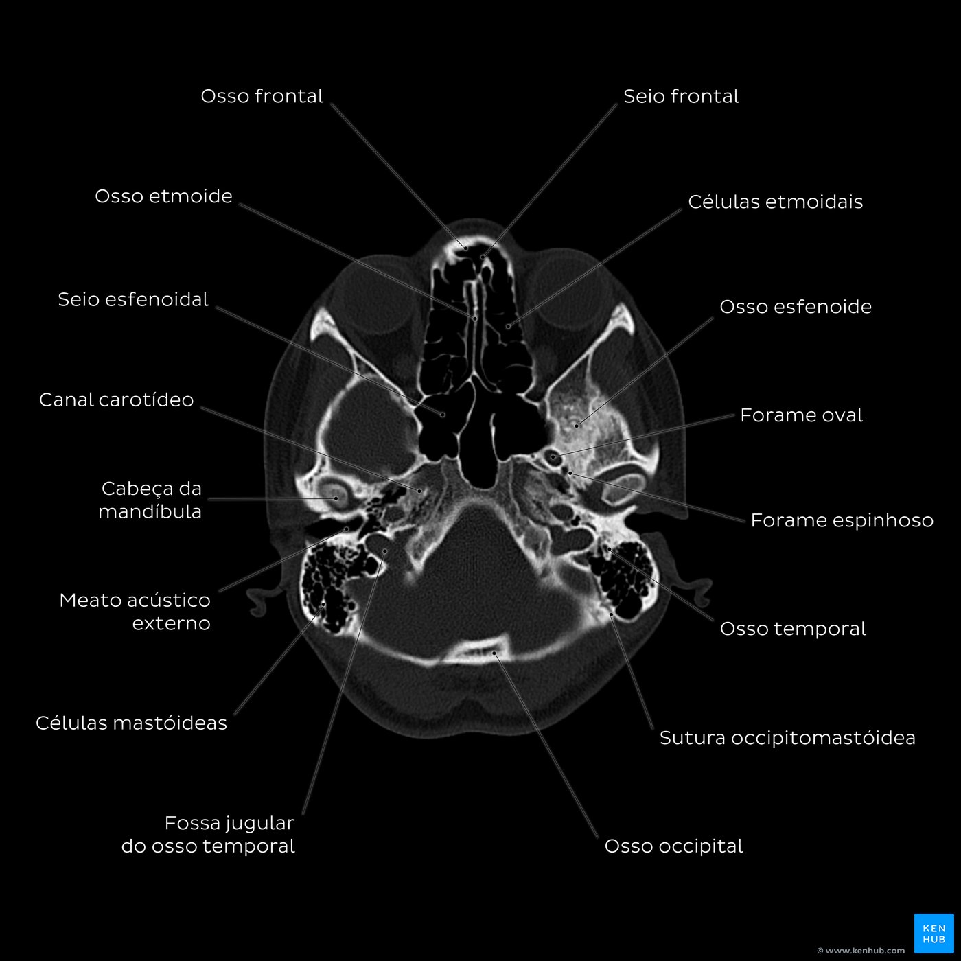 Esquema de TC de crânio ao nível da fossa jugular