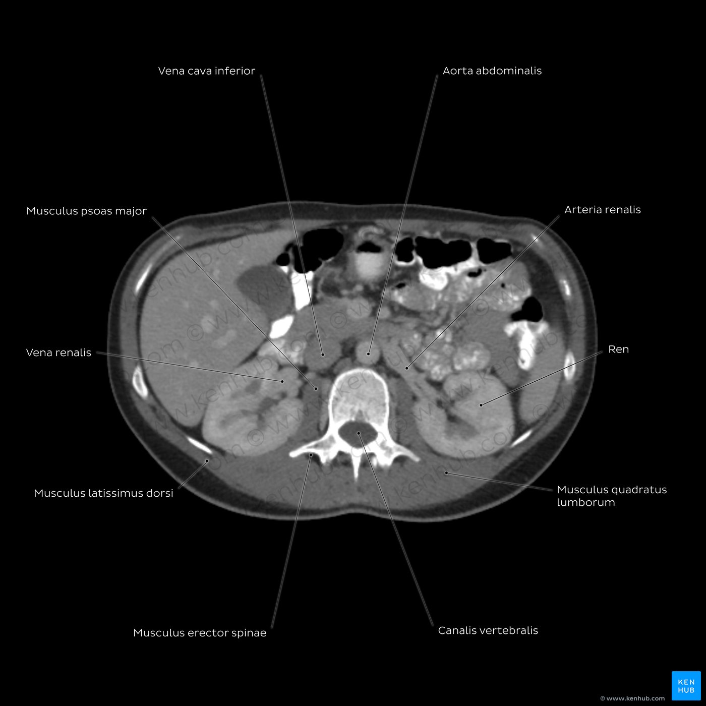 CT des Abdomens auf Höhe des zweiten Lendenwirbels (L2)