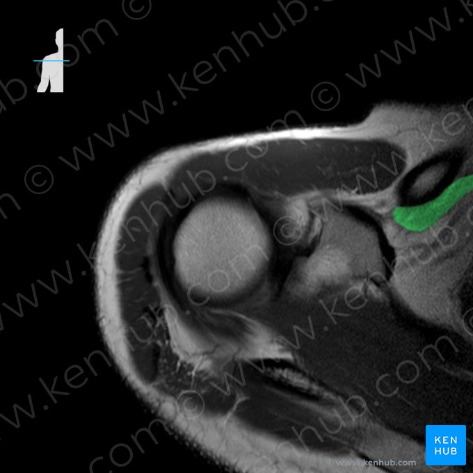 Musculus subclavius (Unterschlüsselbeinmuskel); Bild: 