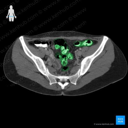 Colon sigmoideo (Colon sigmoideum); Imagen: 