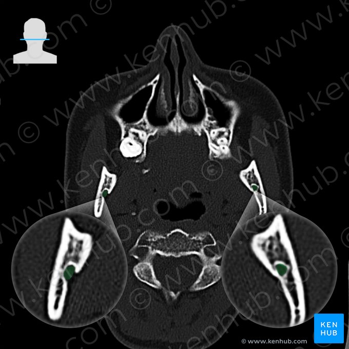 Foramen alveolar inferior (Foramen alveolare inferius mandibulae); Imagen: 