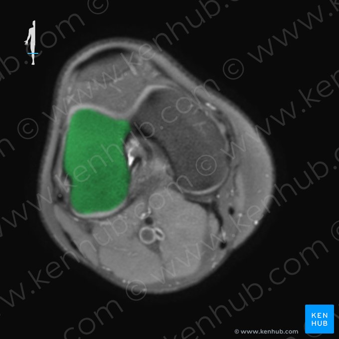 Côndilo lateral do fêmur (Condylus lateralis femoris); Imagem: 