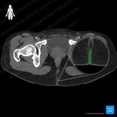 Intergluteal cleft (Crena interglutealis); Image: 