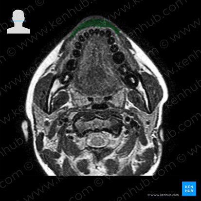 Orbicularis oris muscle (Musculus orbicularis oris); Image: 