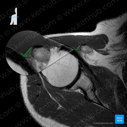 Tendón de la cabeza corta del músculo bíceps braquial (Tendo capitis brevis musculi bicipitis brachii); Imagen: 