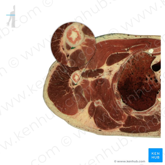 Caput mediale musculi tricipitis brachii (Mittlerer Kopf des dreiköpfigen Oberarmmuskels); Bild: National Library of Medicine