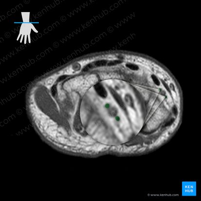 Radial veins (Venae radiales); Image: 